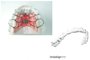 マウスピース矯正